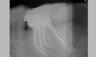 Teeth whitening in Anand                        